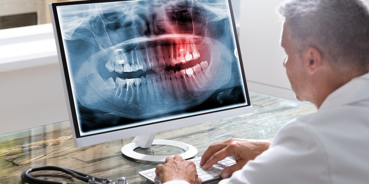 Exploring the Benefits of Digital Dental X-Rays